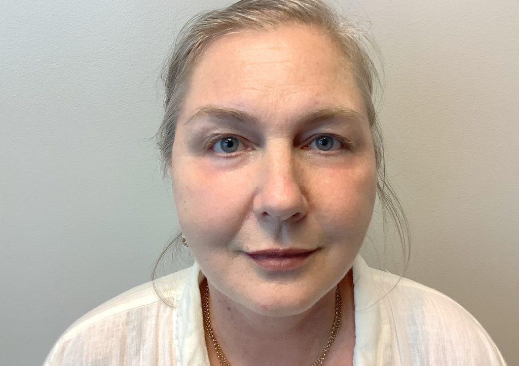 An After Photo of a Facelift with Lower Blepharoplasty Plastic Surgery by Dr. David Santos in Seattle and Tacoma