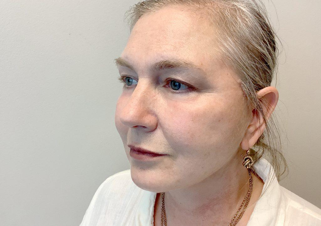 An After Photo of a Facelift with Lower Blepharoplasty Plastic Surgery by Dr. David Santos in Seattle and Tacoma