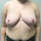 An After Photo of a Breast Lift with Auto Augmentation Plastic Surgery by Dr. Craig Jonov in Seattle and Tacoma