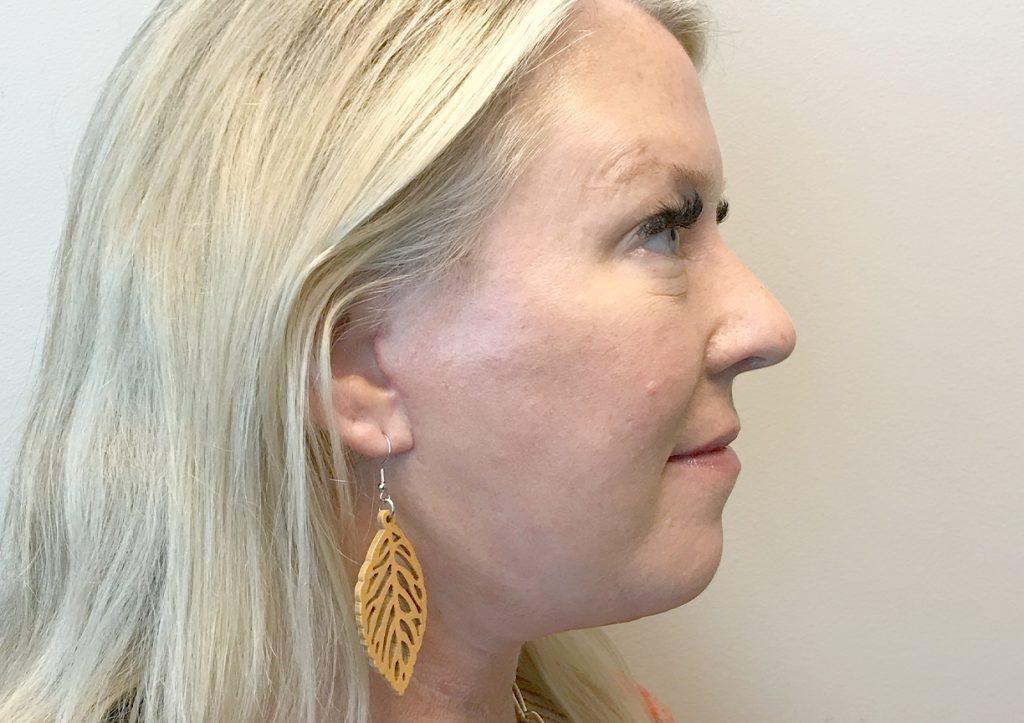 An After Photo of Chin Liposuction Plastic Surgery by Dr. David Santos in Seattle and Tacoma