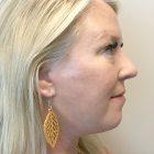 An After Photo of Chin Liposuction Plastic Surgery by Dr. David Santos in Seattle and Tacoma