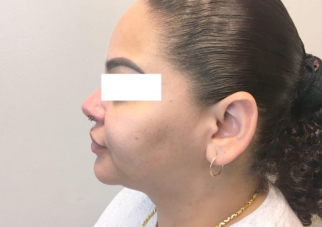 An After Photo of Chin Liposuction Plastic Surgery by Dr. David Santos in Seattle and Tacoma