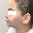 An After Photo of Chin Liposuction Plastic Surgery by Dr. David Santos in Seattle and Tacoma