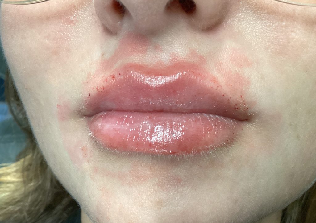 An After Photo of Lip Filler Injections in Seattle and Tacoma