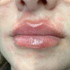 An After Photo of Lip Filler Injections in Seattle and Tacoma