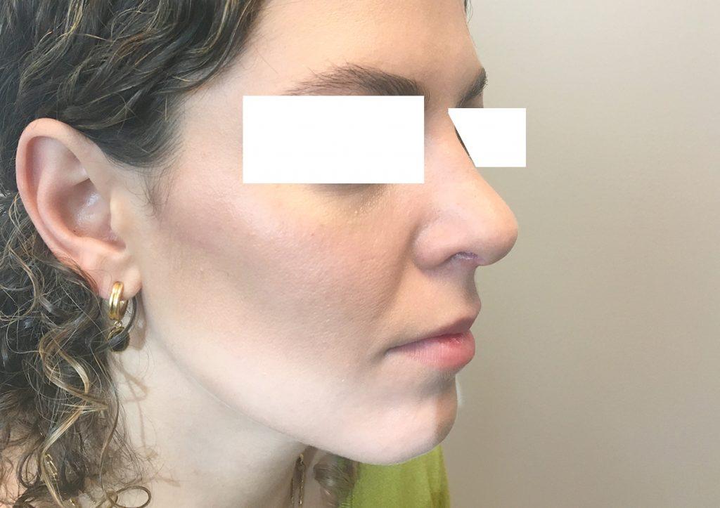 An After Photo of Rhinoplasty Plastic Surgery by Dr. David Santos in Seattle and Tacoma