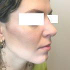 An After Photo of Rhinoplasty Plastic Surgery by Dr. David Santos in Seattle and Tacoma