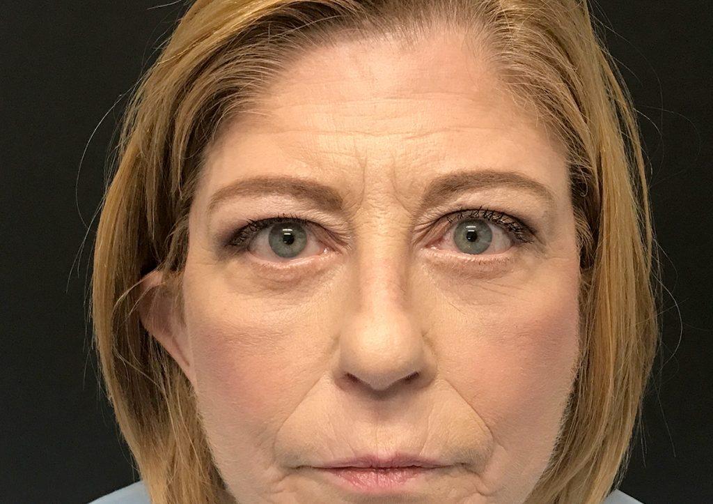 An After Photo of A Swiftlift, Brow Lift, Eyelid Surgery Plastic Surgery by Dr. Craig Jonov in Seattle and Tacoma