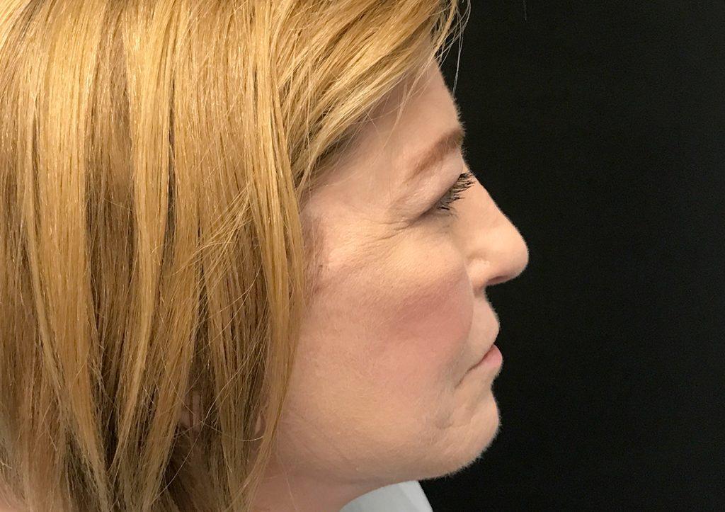 An After Photo of A Swiftlift, Brow Lift, Eyelid Surgery Plastic Surgery by Dr. Craig Jonov in Seattle and Tacoma
