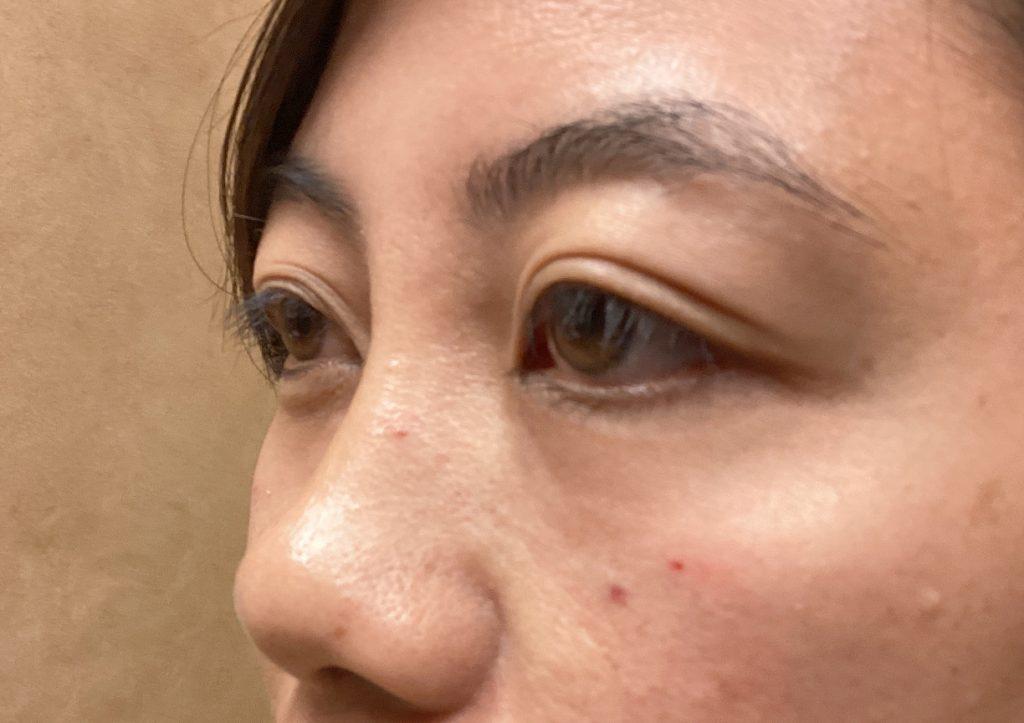 An After Photo of Tear Trough Filler in Seattle and Tacoma