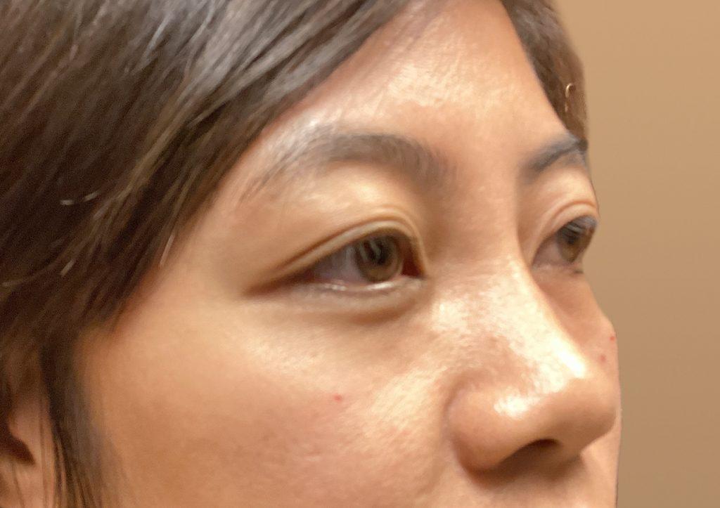 An After Photo of Tear Trough Filler in Seattle and Tacoma