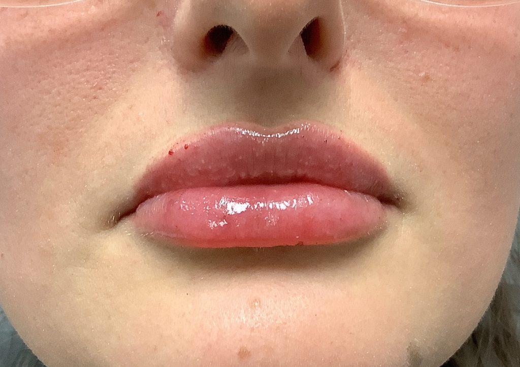 An After Photo of Restylane Kysse Lip Filler in Seattle and Tacoma