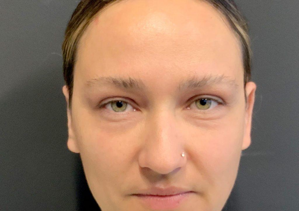 An After Photo of an Otoplasty Plastic Surgery by Dr. Craig Jonov in Seattle and Tacoma