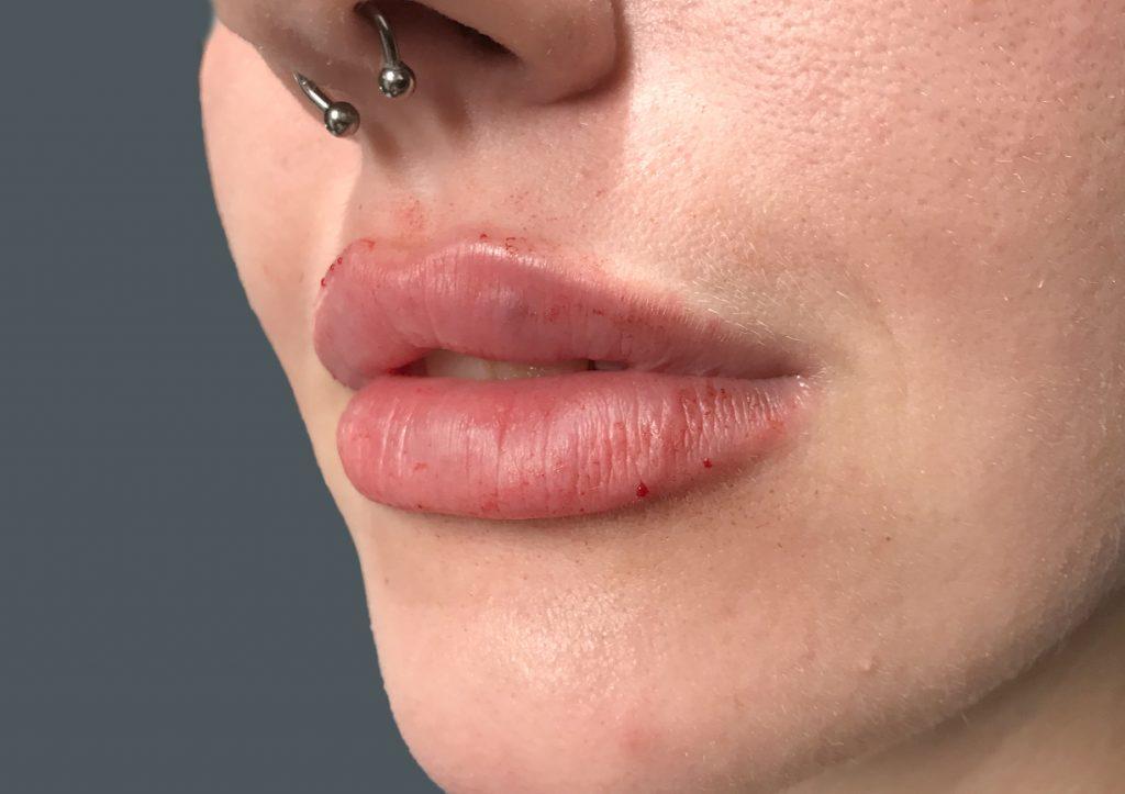 An After Photo of Lip Filler Injections in Seattle and Tacoma