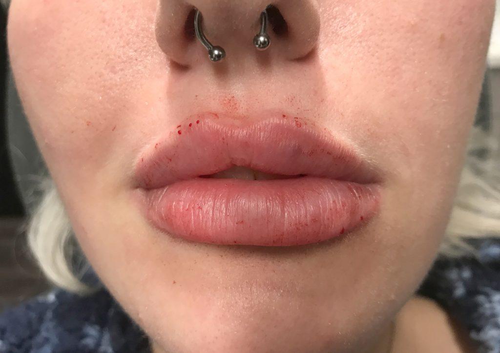 An After Photo of Lip Filler Injections in Seattle and Tacoma