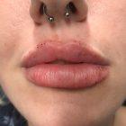 An After Photo of Lip Filler Injections in Seattle and Tacoma