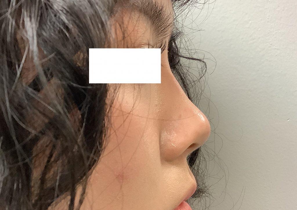 An After Photo of Non-Surgical Rhinoplasty Seattle and Tacoma
