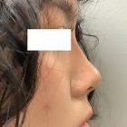 An After Photo of Non-Surgical Rhinoplasty Seattle and Tacoma