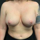 An After Photo of a Breast Revision Plastic Surgery by Dr. Craig Jonov in Seattle and Tacoma