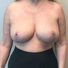 An After Photo of Breast Reduction with Lift Plastic Surgery by Dr. Craig Jonov in Seattle and Tacoma