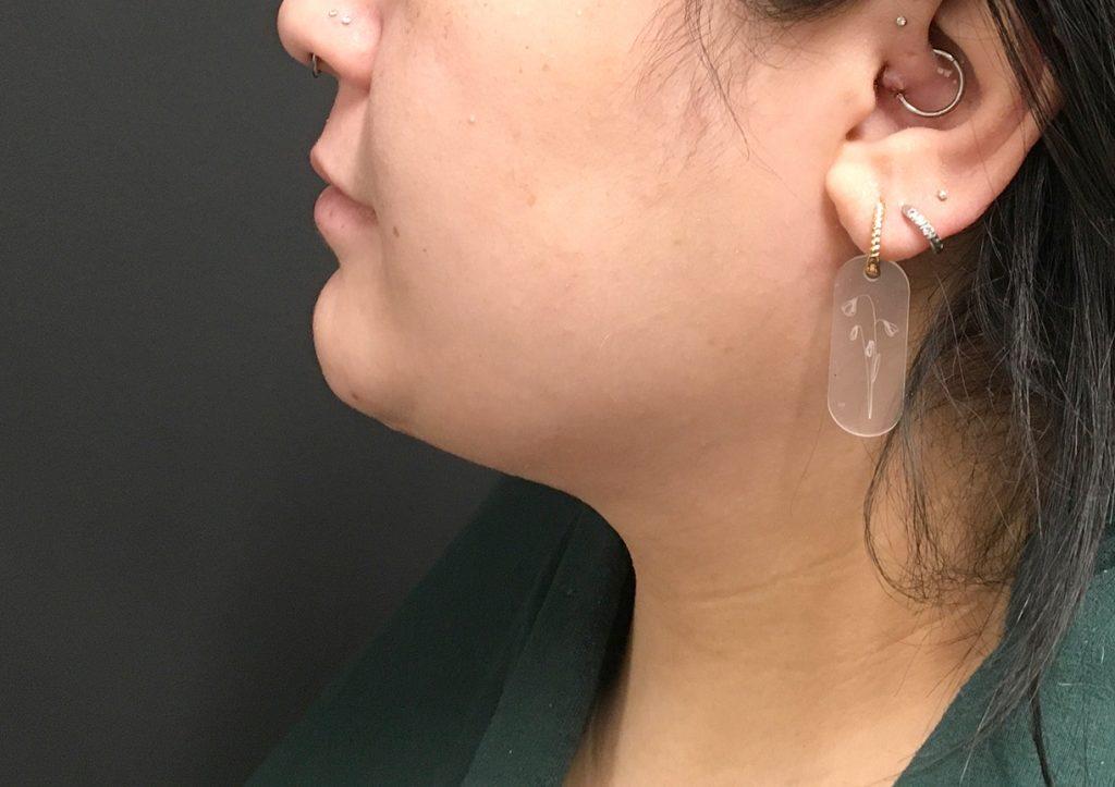 An After Photo of Chin Liposuction & Submentoplasty Plastic Surgery by Dr. Craig Jonov in Seattle and Tacoma