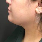 An After Photo of Chin Liposuction & Submentoplasty Plastic Surgery by Dr. Craig Jonov in Seattle and Tacoma