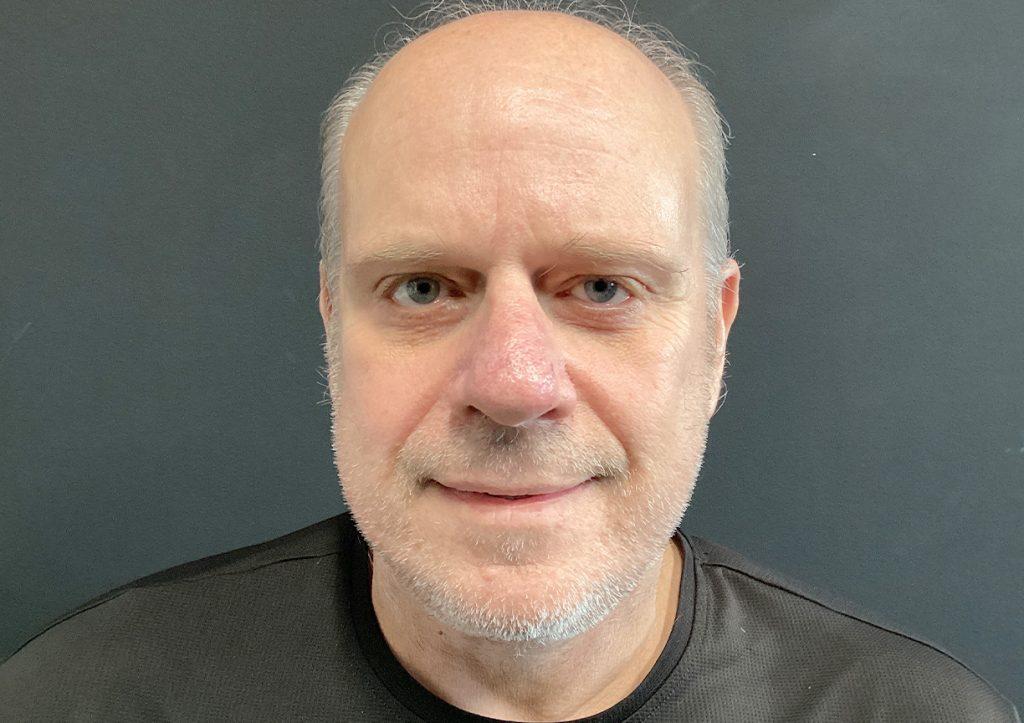 An After Photo of a Male Facelift, Neck Lift, & Lower Blepharoplasty Plastic Surgery in Seattle and Tacoma