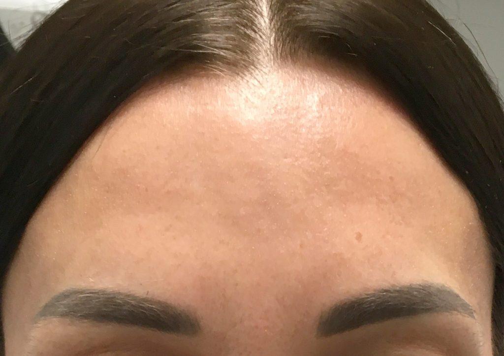 An After Photo of Botox Injections in Seattle and Tacoma