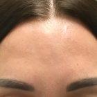 An After Photo of Botox Injections in Seattle and Tacoma