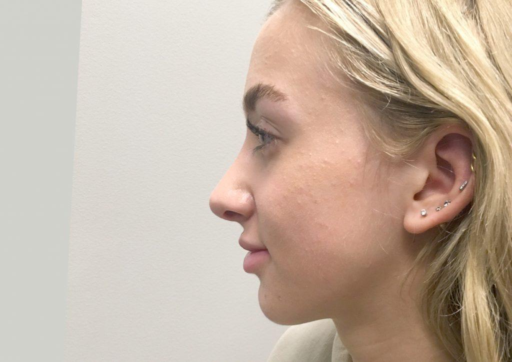 An After Photo of a Rhinoplasty Plastic Surgery by Dr. Craig Jonov in Seattle and Tacoma