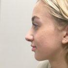 An After Photo of a Rhinoplasty Plastic Surgery by Dr. Craig Jonov in Seattle and Tacoma