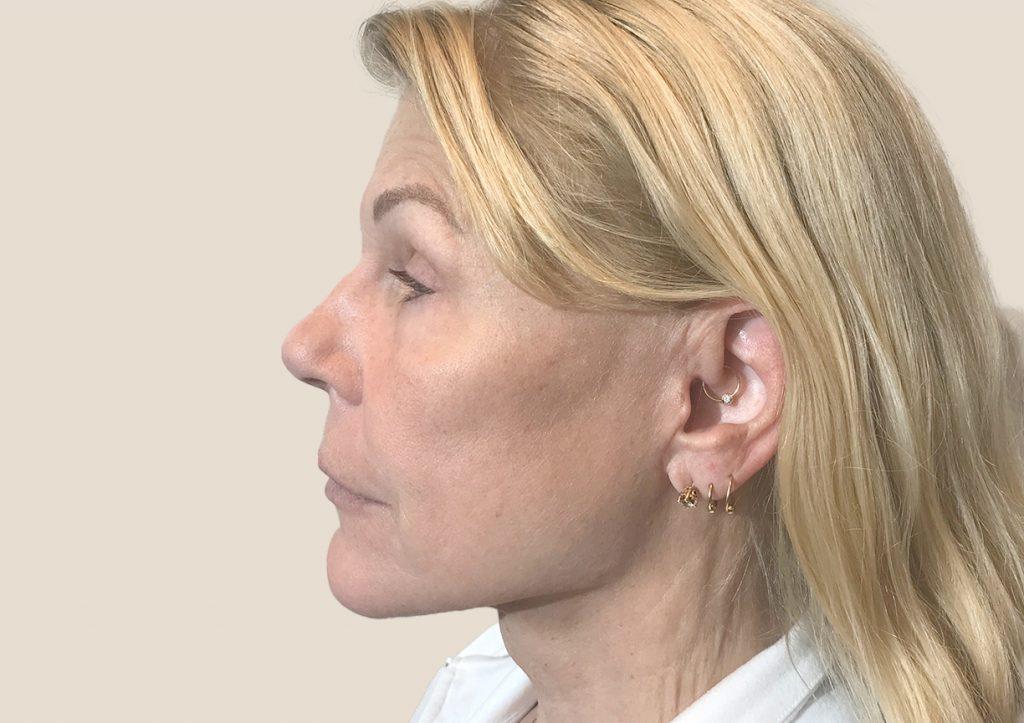 An After Photo of a Mini Facelift Plastic Surgery by Dr. David Santos in Seattle and Tacoma