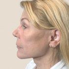 An After Photo of a Mini Facelift Plastic Surgery by Dr. David Santos in Seattle and Tacoma