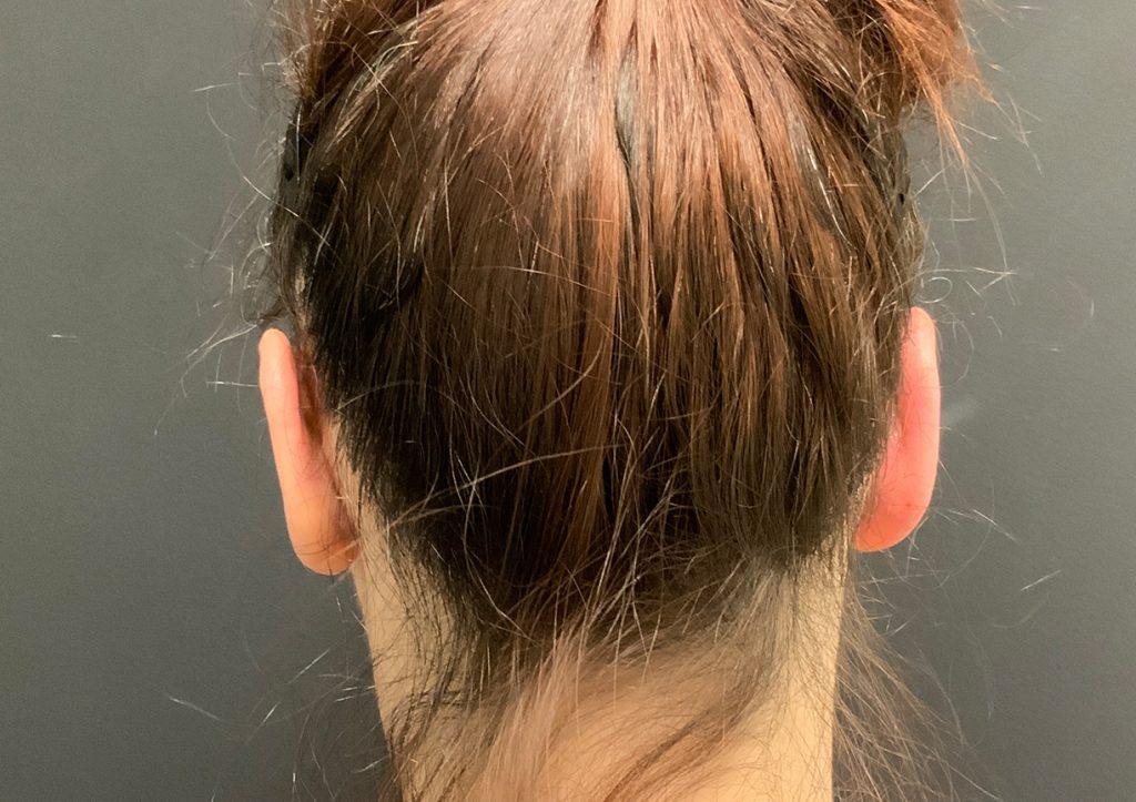 An After Photo of Otoplasty Plastic Surgery by Dr. Craig Jonov in Seattle and Tacoma