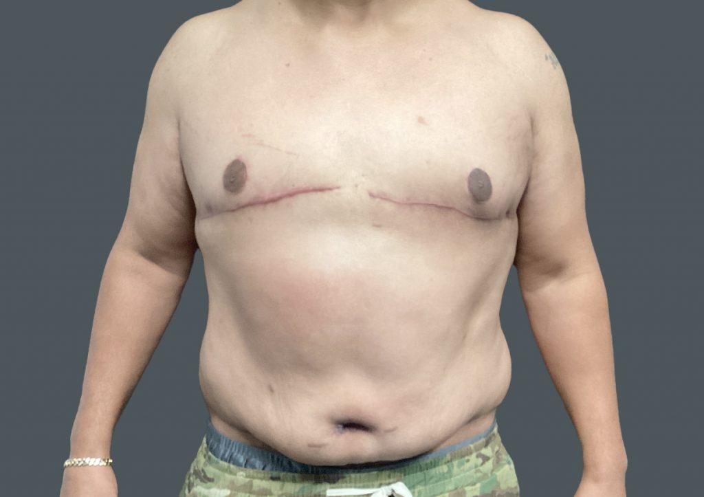 An After Photo of Gynecomastia Plastic Surgery by Dr. Craig Jonov in Seattle and Tacoma
