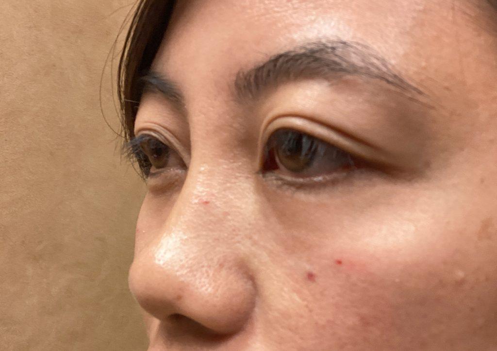 An After Photo of Under Eye Filler in Seattle and Tacoma