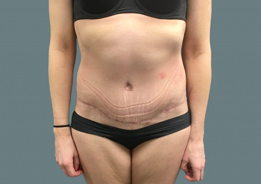 An After Photo of a Tummy Tuck Plastic Surgery by Dr. Craig Jonov in Seattle and Tacoma