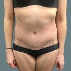 An After Photo of a Tummy Tuck Plastic Surgery by Dr. Craig Jonov in Seattle and Tacoma