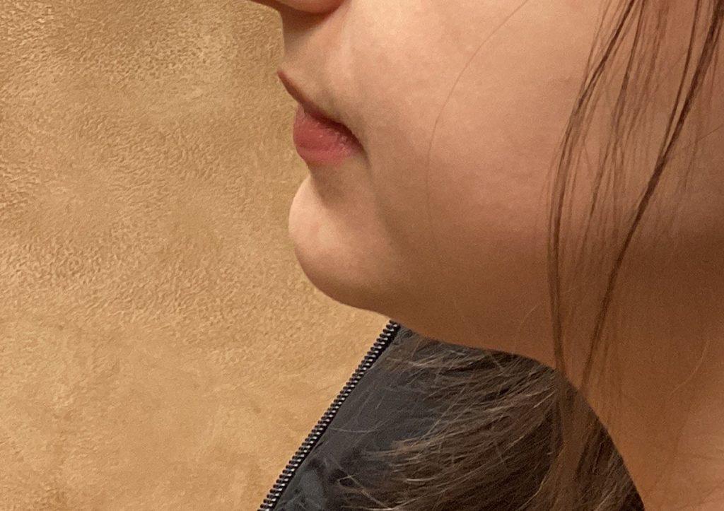 An After Photo of Chin Filler in Seattle and Tacoma