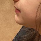 An After Photo of Chin Filler in Seattle and Tacoma