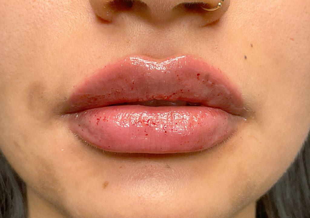 An After Photo of Restylane Kysse Lip Filler in Seattle and Tacoma