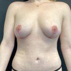 An After Photo of an Auto Augmentation with Breast Lift Plastic Surgery by Dr. Craig Jonov in Seattle and Tacoma