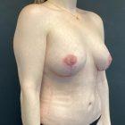 An After Photo of an Auto Augmentation with Breast Lift Plastic Surgery by Dr. Craig Jonov in Seattle and Tacoma