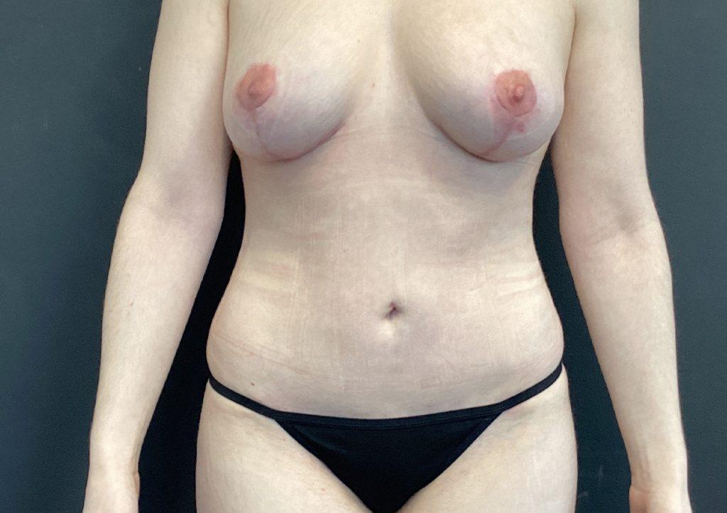 An After Photo of a Mini Tummy Tuck Plastic Surgery by Dr. Craig Jonov in Seattle and Tacoma