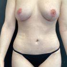 An After Photo of a Mini Tummy Tuck Plastic Surgery by Dr. Craig Jonov in Seattle and Tacoma