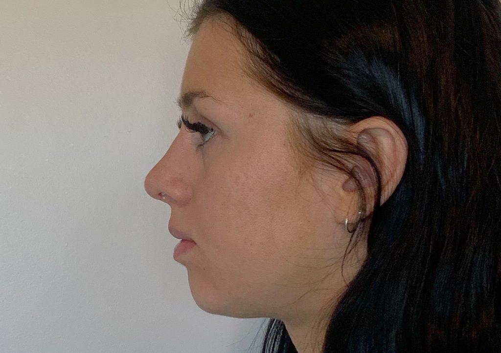 An After Photo of a Rhinoplasty Plastic Surgery by Dr. Craig Jonov in Seattle and Tacoma