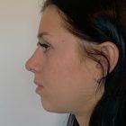 An After Photo of a Rhinoplasty Plastic Surgery by Dr. Craig Jonov in Seattle and Tacoma