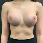 An After Photo of a Breast Augmentation Plastic Surgery by Dr. Craig Jonov in Seattle and Tacoma