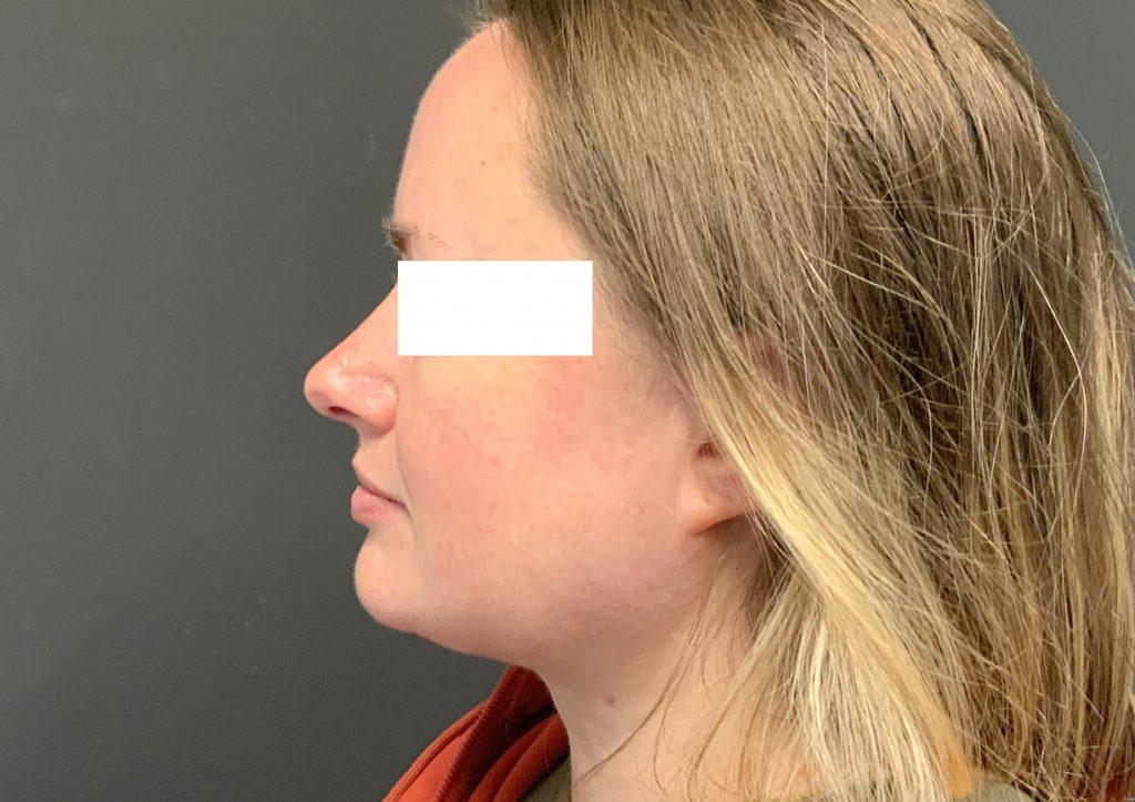 An After Photo of Chin Liposuction Plastic Surgery by Dr. Craig Jonov in Seattle and Tacoma