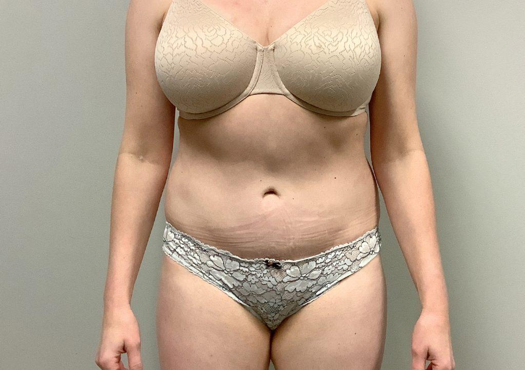An After Photo of a Tummy Tuck Plastic Surgery by Dr. Craig Jonov in Seattle and Tacoma
